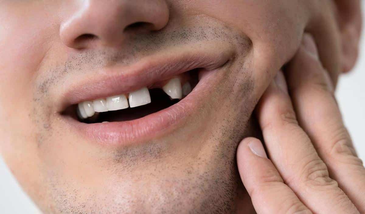 Comment réparer une dent cassée ? Santé 365